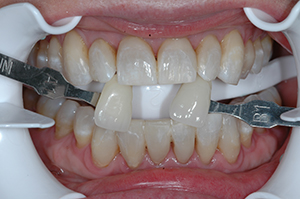 Bleaching_after